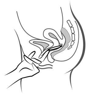 Schematic drawing showing a hand holding an applicator being inserted into the vagina, depicted in a lateral section of the female pelvis