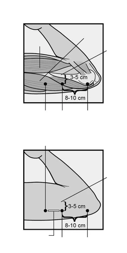 Anatomical schematic of the arm with black dots and measurements indicating distances of 3–5 cm and 8–10 cm from the joint and elbow crease
