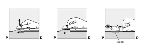 Three schematics showing hand movements over an implant, arrows indicate direction of motion with a prohibition sign against pressing on the implant in the final step