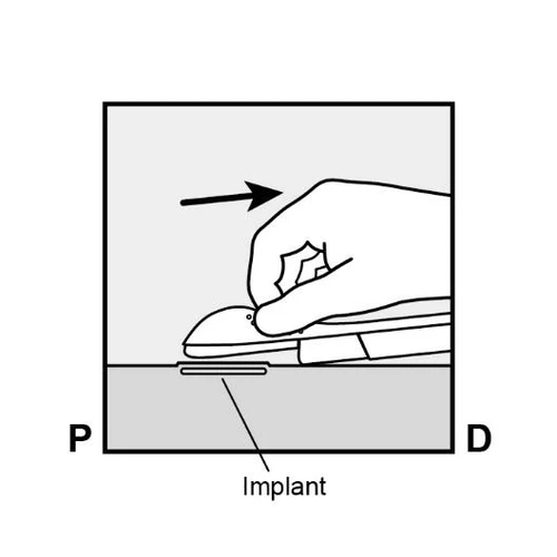Hand pressing a medical device onto an implant placed on a flat surface, arrow indicating movement direction to the right