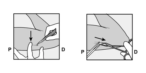 Schematic of drug administration: left side shows skin puncture with a needle, right side shows needle advancement along the subcutaneous tissue