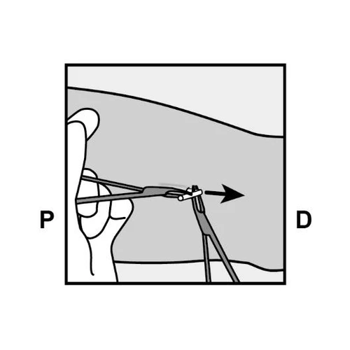 Schematic illustration showing hand holding a syringe with needle directed toward the body, letter designations P and D on both sides