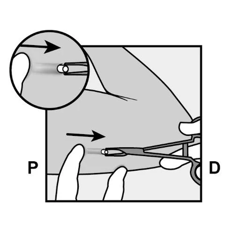 Schematic showing method of drug administration, one hand stabilizes the skin while the other hand moves the applicator in the direction marked with the letter D