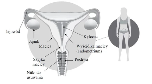 Anatomical diagram of the female reproductive system labeled with: fallopian tube, ovary, uterus, Kyleena, endometrial lining, cervix, vagina, and removal threads