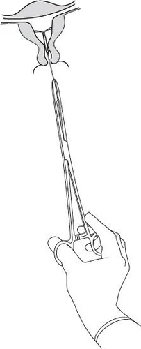 Hand holding metal forceps inserting a thin needle into the uterus of a female depicted in an anatomical schematic