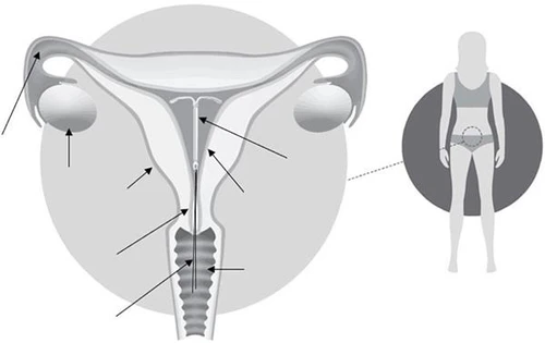 Anatomical diagram of the female reproductive system showing an enlarged uterus, ovaries, and cervix, along with a female silhouette indicating the location of the organs