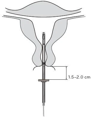 Anatomical diagram of the uterus with an intrauterine device and cervix in place, indicating an insertion depth of 1.5–2.0 cm