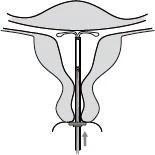 Anatomical diagram of the female reproductive system with an intrauterine device placed inside the uterus and cervix, with an arrow indicating direction