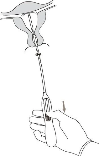 Hand holding an applicator inserting a T-shaped intrauterine device into the uterus; an arrow indicates downward movement