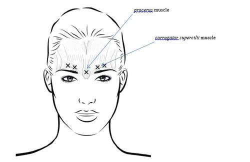 Esquema del rostro femenino con los músculos procero y corrugador del supercilio marcados mediante líneas y símbolos en forma de cruz en la frente