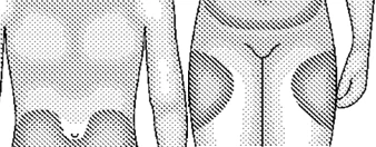 Schematic human figure with darker areas marked on the lower abdomen and on the sides of the hips and thighs