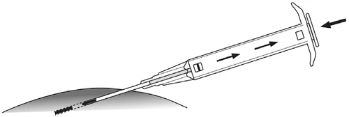 Pluma inyectable con la aguja insertada en una superficie corporal convexa, una flecha indica el movimiento del émbolo en la dirección de administración del medicamento hacia el interior del tejido