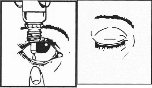 Dibujo que muestra una gota de medicamento cayendo en un ojo abierto, y al lado, un ojo cerrado durante el proceso de aplicación del fármaco ocular