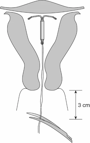 Schema anatomico che mostra il posizionamento intrauterino di un dispositivo intrauterino con distanza indicata di 3 cm dal collo dell'utero