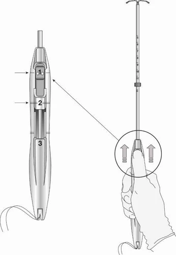 Schema di un dispositivo medico con ingrandimento della parte centrale con numeri 1, 2 e 3 e una mano che impugna una siringa lunga con stantuffo