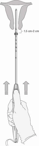 Schema che mostra una mano che impugna un applicatore che inserisce un ago lungo nell'utero a una profondità compresa tra 1,5 e 2 cm