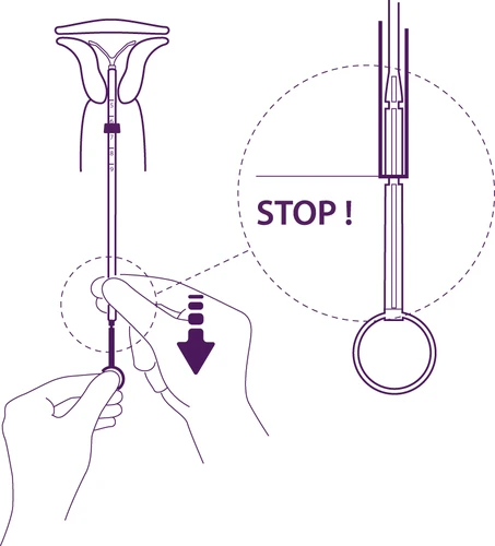 Schematic application instructions for intrauterine device placement, showing hands holding the tube and a close-up highlighting the moment to stop at the 'STOP' mark