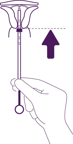 A hand holding an applicator with a numerical scale directed toward the uterus, with a large adjacent arrow indicating upward movement