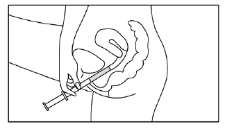 A schematic black-and-white illustration showing a hand holding a syringe being inserted into the rectum in a lateral position