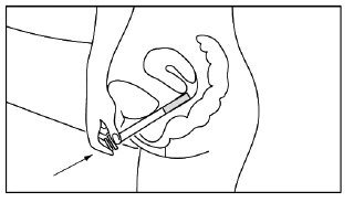 A schematic anatomical drawing depicting application of medication to the genital area using a thin applicator directed into the body