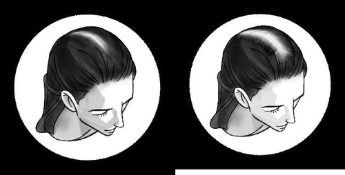 Dos gráficos en blanco y negro que muestran el perfil de la cabeza de una mujer con áreas visibles de pérdida de cabello en la coronilla y en la parte posterior de la cabeza