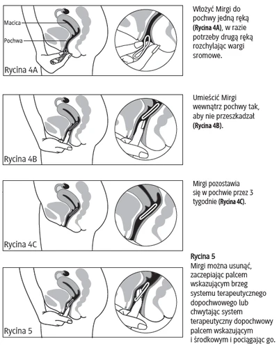 A series of medical diagrams showing four steps of using the device: inserting the device into the vagina, placing it inside, leaving it for 3 weeks, and removal