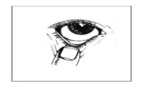 Primer plano del ojo humano con una gota de medicamento cayendo directamente sobre la superficie del globo ocular y el párpado inferior