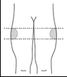 Schematic illustration of legs with two gray areas marked on the thighs, bounded by horizontal dashed lines indicating the injection site