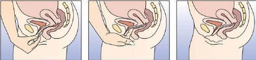 Tre schemi di sezione del bacino femminile che mostrano il processo di inserimento di una compressa vaginale da parte di una mano all'interno della vagina