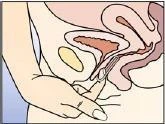 Schema anatomico degli organi pelvici femminili con una mano che inserisce una compressa vaginale all'interno della vagina, accanto alla vescica e all'utero