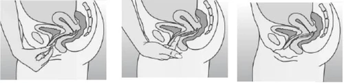 Three anatomical diagrams showing the process of inserting a tampon into the vagina by a hand at various stages of application within the pelvis
