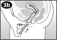 Esquema de sección de la pelvis que muestra una mano sosteniendo una jeringa que introduce una aguja en el interior de la vagina para administrar un medicamento