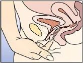 Anatomical diagram of female pelvic organs showing the uterus, bladder, and vagina, with a hand holding an applicator being inserted into the vagina