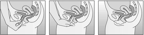 Three diagrams of the female pelvis showing the process of inserting a tampon or suppository into the vagina using a hand holding the product