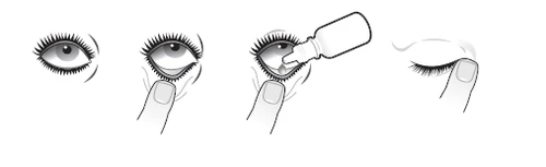 Schema delle istruzioni per l'instillazione delle gocce oculari: occhio aperto, allontanamento della palpebra inferiore con il dito, instillazione delle gocce dal flacone e occhio chiuso dopo il trattamento