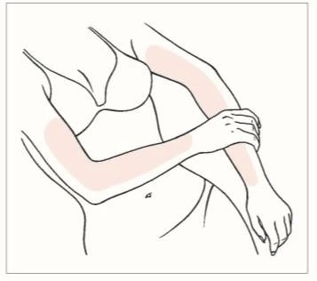 Disegno schematico del tronco femminile con macchie rosa sulla parte superiore delle braccia e sull'avambraccio del braccio sinistro