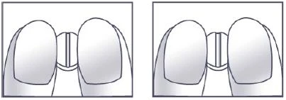 Two identical diagrams showing a close-up of the upper front teeth with a marked vertical gap between the two central incisors