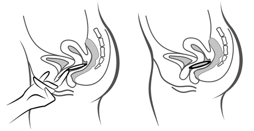 Two schematic illustrations of a female pelvic cross-section showing a hand inserting a tablet into the vagina using an applicator