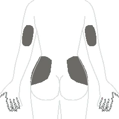 Sagoma schematica del tronco umano visto da dietro con aree scure evidenziate sulle spalle e su entrambi i lati dei glutei
