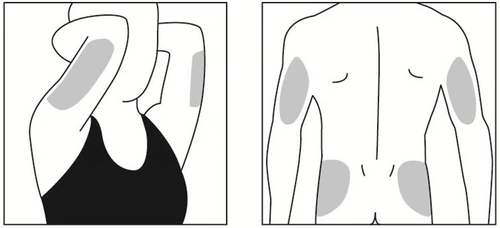 Schematic drawings showing injection sites on the arms and upper parts of the buttocks marked with gray areas