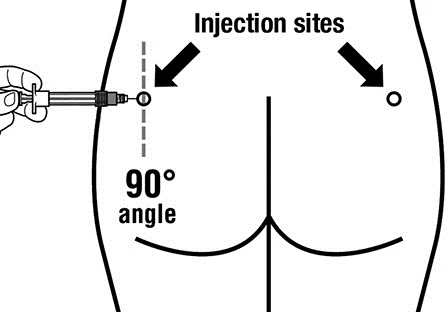 Schema che illustra l'iniezione nel gluteo a un angolo di 90 gradi, con due punti di iniezione indicati e una mano che tiene la siringa
