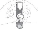 Dibujo esquemático que muestra el montaje o conexión de dos elementos mecánicos dentro de una estructura anatómica del cuerpo
