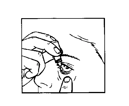Una mano tiene un piccolo flacone di collirio e applica il medicinale all'occhio, mentre l'altra mano tira delicatamente la palpebra inferiore del paziente