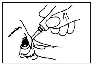A hand holding a small bottle with an applicator, from which a drop of medication falls directly into a close-up view of the eye