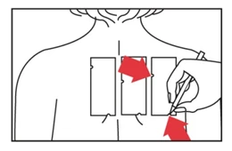 Schematic outline of the back with three rectangular areas, a hand holding a pen marking one area, and red arrows indicating direction of application