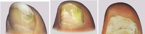 Tre primi piani ravvicinati di dita con unghie danneggiate, ingiallite, ispessite e con struttura irregolare e desquamante tipica della micosi