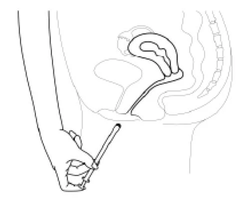 Ilustración anatómica que muestra un corte transversal de los órganos pélvicos femeninos y una mano que sostiene un aplicador introducido en la vagina