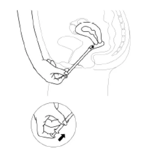 Dibujo esquemático de una mano sosteniendo un aplicador que introduce medicamento en el ano, con un primer plano que muestra cómo se presiona el émbolo del dispositivo