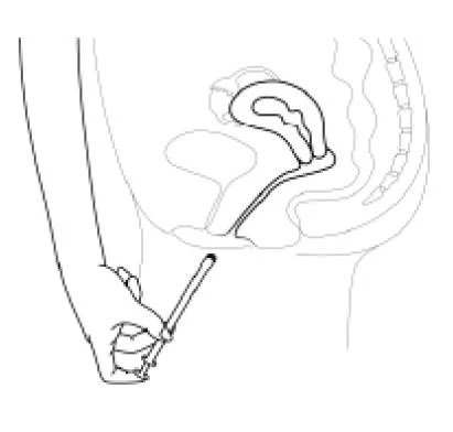 Schema anatomico del bacino femminile con utero e vescica visibili, e una mano che impugna un applicatore inserito nella vagina