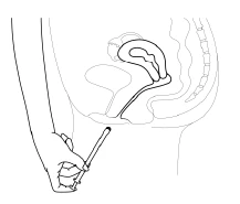 Schema anatomico degli organi pelvici e addominali femminili, con una mano che impugna un applicatore inserito nella vagina per la somministrazione di un farmaco